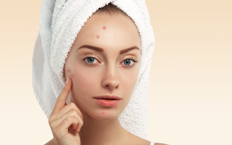Close up shot of young Caucasian female with blue eyes and acne skin, pointing at pimple, looking at the camera while getting facial treatment in spa salon. Dermatology and problem skin concept